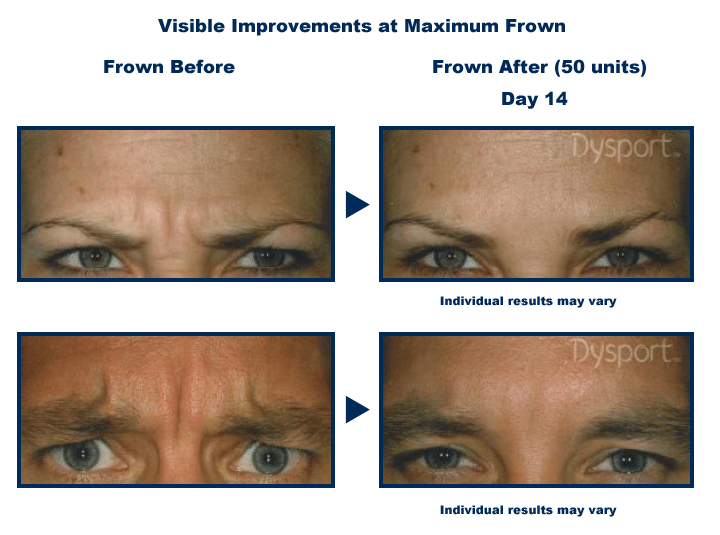 dysport before and after frown lines