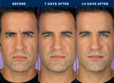 before and after pics of male patient 14 days after botox injection