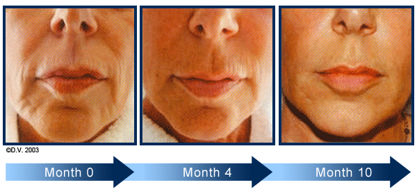 sculptra photograph of woman showing effects of treatment from zero to ten months