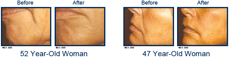 52 yr old woman and 47 year old woman before and after sculptra treatments