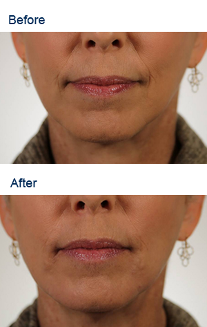 Revenesse Versa is a hyaluronic acid dermal filler used to treat moderate to severe facial wrinkles and folds, including nasolabial folds: Before and After Pictures