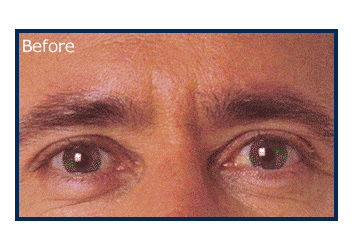 botox for men before and after picture