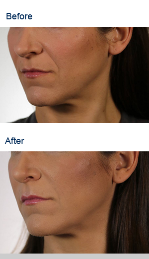 Revenesse Versa is a hyaluronic acid dermal filler used to treat moderate to severe facial wrinkles and folds, including nasolabial folds: Before and After Pictures